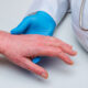 A Comprehensive Review on Systemic Therapies for Atopic Dermatitis (Eczema)