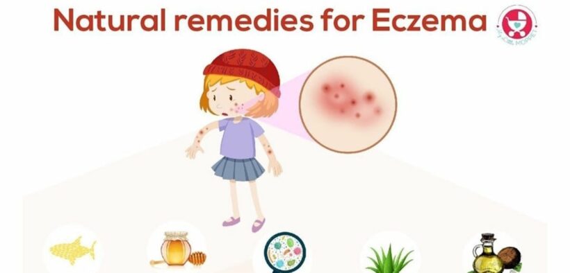 Home Remedies for Eczema: Dermatologist-Approved DIY Treatments