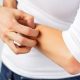 Technoderma begins dosing in atopic dermatitis therapy trial