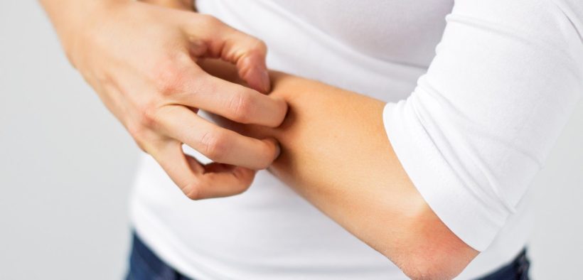 Technoderma begins dosing in atopic dermatitis therapy trial