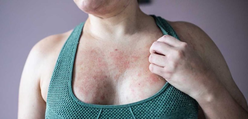 Eczema and Stress: Triggers, Connection, and More