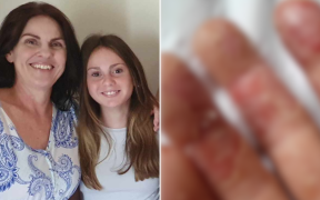 Signs of eczema: Aussie mum and daughter taunted for being ‘contagious’ hit back at bullies to raise awareness