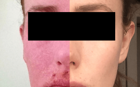 Dr. Marvin Rapaport helps people overcome topical steroid withdrawal  | YourCentralValley.com